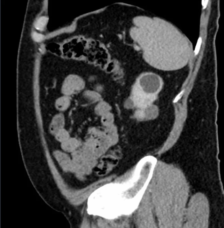 CT intravenózní zobrazující mnohočetný tumor  levé ledviny.  Fig. 1. Venous phase CT showing multiple tumors of left  kidney. 