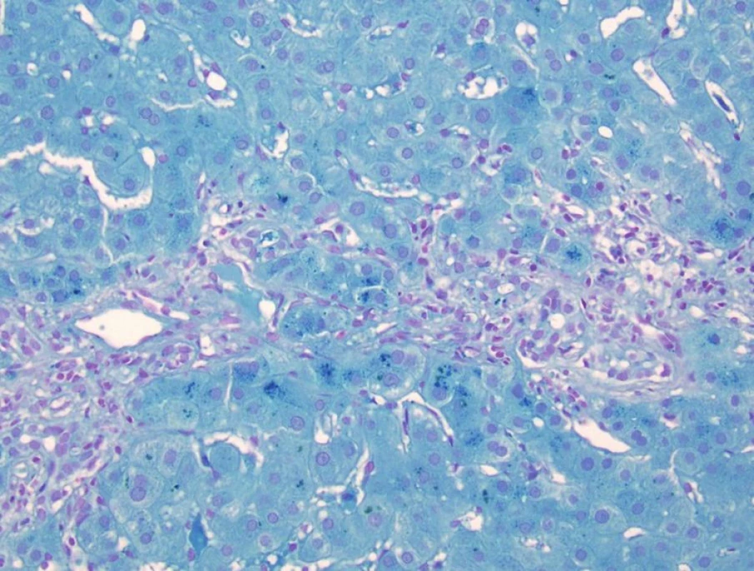 Typická morfologie poruchy žlučové drenáže s edémem port. pole v centru a s akumulací metaloproteinu v periportálních/ periseptálních hepatocytech. Ve stejné lokalitě může být v hepatocytech i Malloryho hyalin jako důsledek toxického působení akumulovaných žlučových kyselin a mědi na cytoskelet hepatocytů.