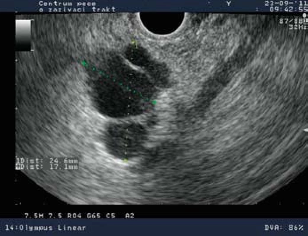 Lineárna endosonografia: trilokulárna cysta v hlave pankreasu.
Fig. 2. Linear-array endosonography: trilocular cyst in the pancreatic head.