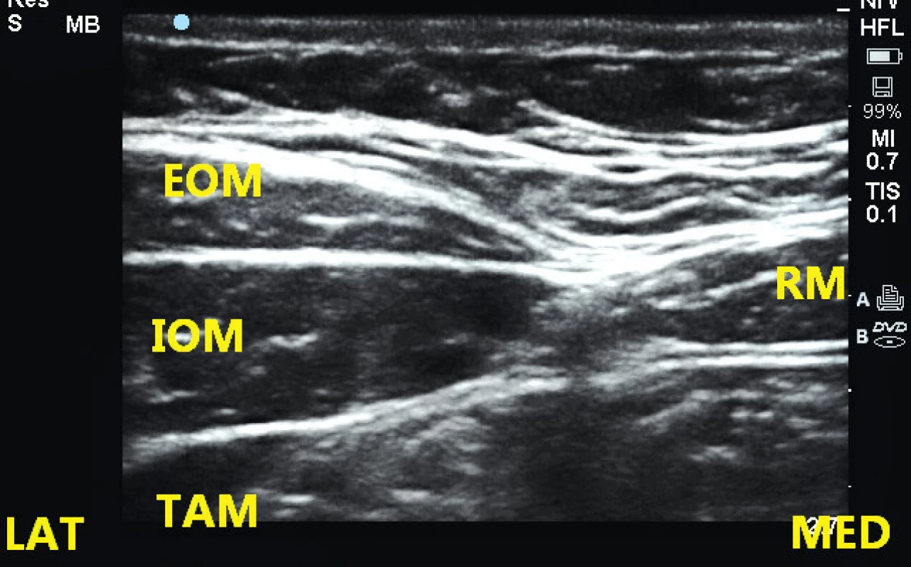 Ultrazvuková anatomie pod úrovní pupku
EOM – m. obliquus abdominis externus, IOM – m. obliquus abdominis internus, TAM – m. transversus abdominis, RM – m. rectus abdominis