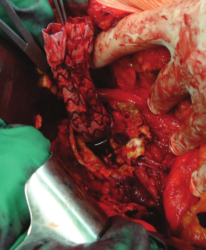 Extrahování stentgraftu
Fig. 16: Extracting the stentgraft