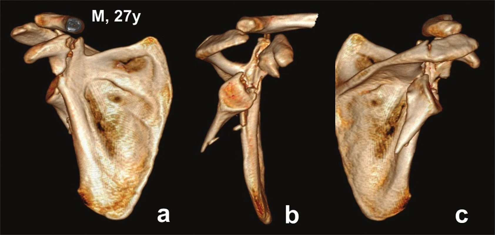 Glenoid fossa fractures (two fragments) with separation through the coracoid process and acromion fracture − CT 3D reconstructions (Pt − 6)