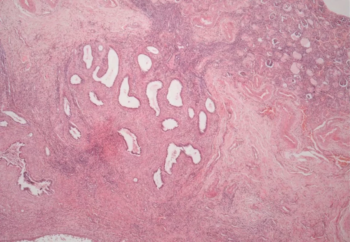 Chronické sklerotické změny. Barvení: hematoxylin-eozin, zvětšeno 100×.