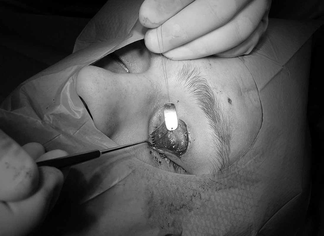 Fixace implantátu k tarzu