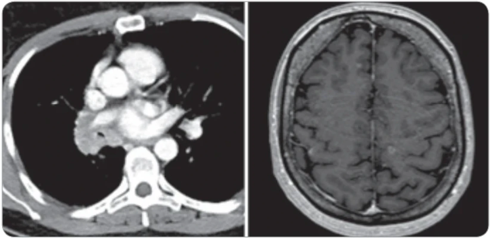 Centrálně uložený tumor pravé plíce před zahájením léčby. Drobné kortikálně uložené metastázy obou mozkových hemisfér. 