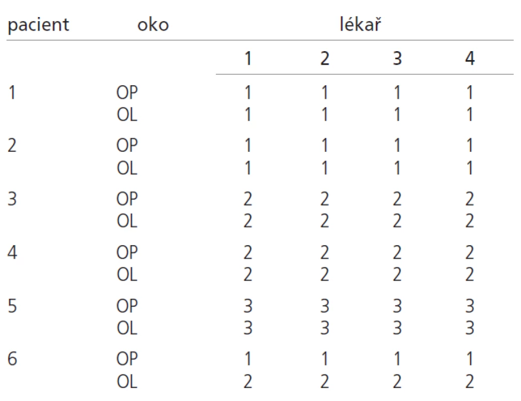 Klasifikace papiledémů do jednotlivých stádií.