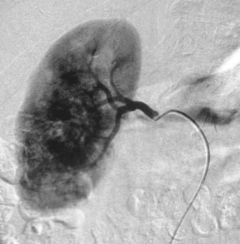 Angiografie pravé renální tepny s patrnou typickou chaotickou maligní vaskularizací Grawitzova tumoru.