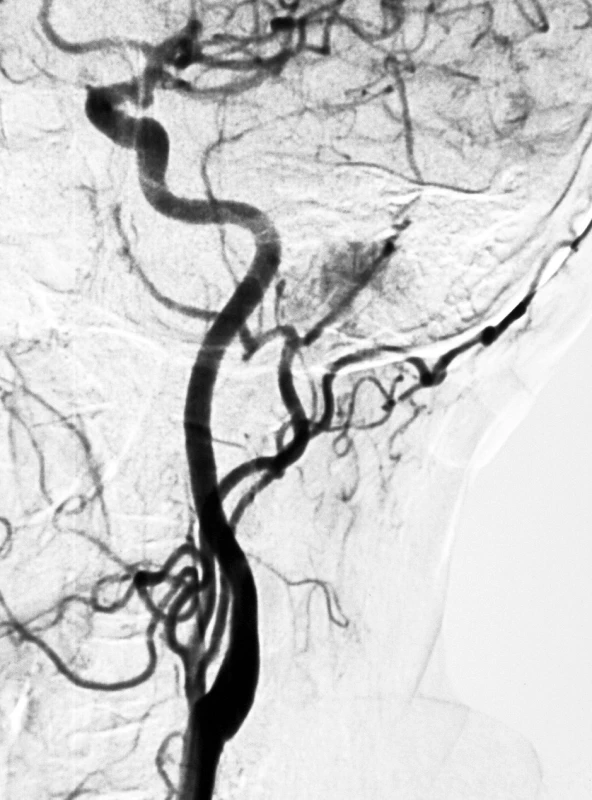 Angiografia zobrazuje tumor, ktorý sa vysycuje po podaní kontrastnej látky.
