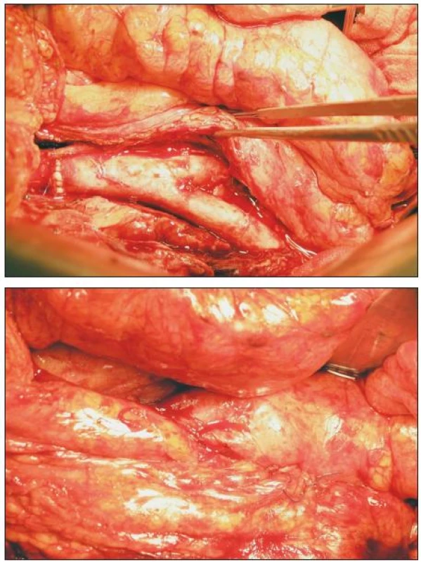 TAG in situ; překryt omentoplastikou
Fig. 5. TAG in situ; covered by omentoplasty