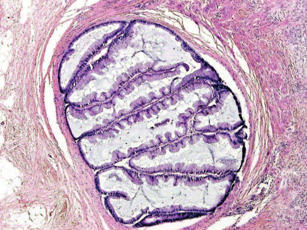Serrated karcinom invazivně rostoucí do muscularis propria (HE, objektiv x20).