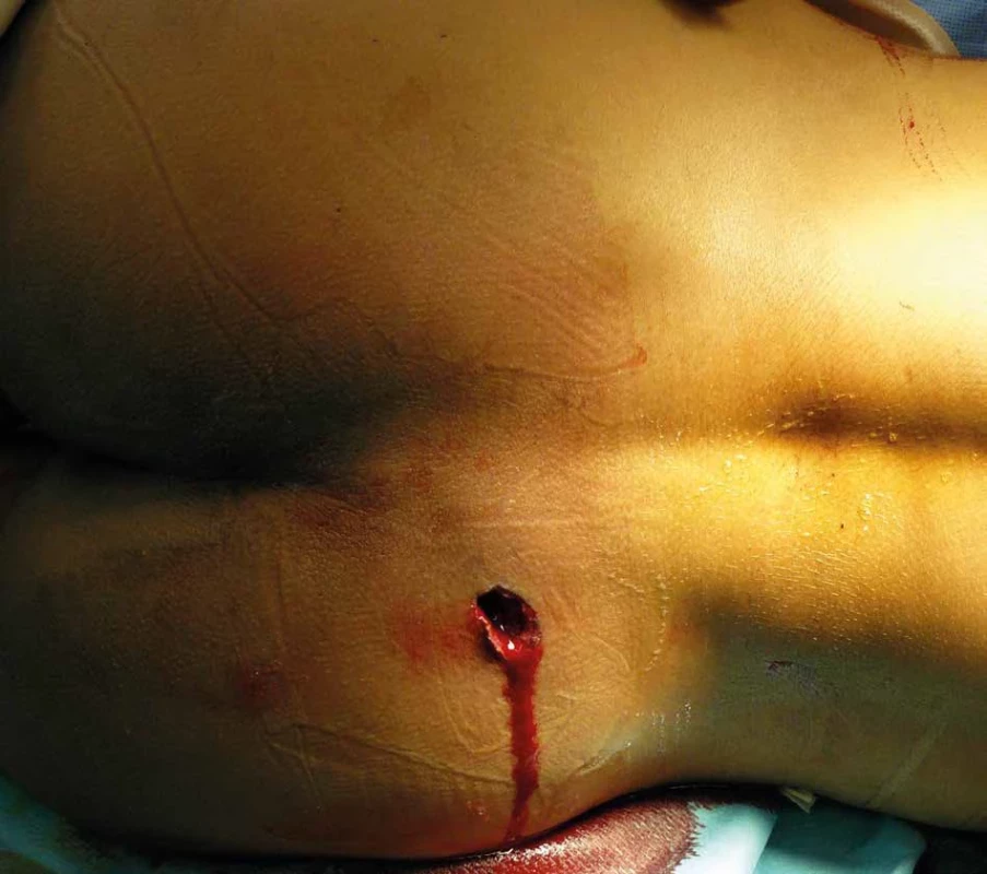 Střelné poranění gluteální krajiny a rekta   Fig. 4: Gunshot wound of the gluteal region and rectum
