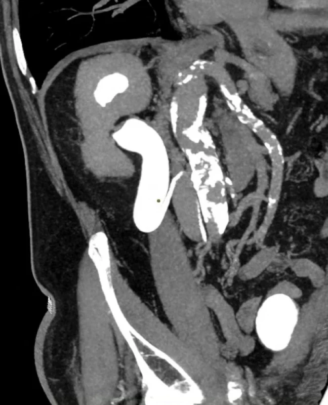  CT urografie – MIP (maximum intensity projection) rekonstrukce zobrazující pravostranný retrokavální ureter. Fig. 1. CT urography – MIP (maximum intensity projection) reconstruction demonstrating a right-sided retrocaval ureter. 