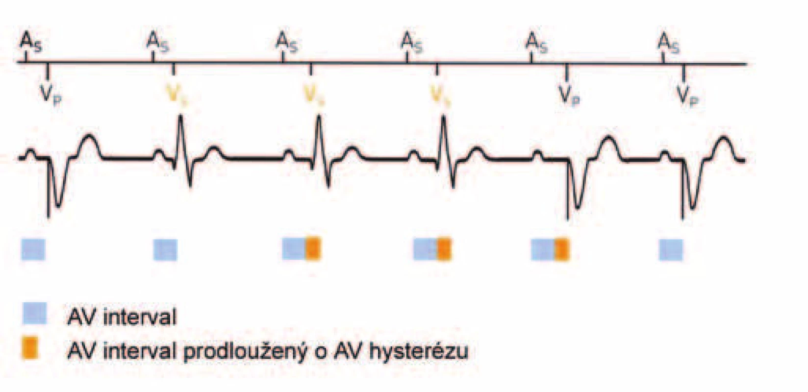 AV-hystereze. Prodloužení AV-intervalu při detekci spontánního síňokomorového vedení je následně vzhledem k uplatnění komorové stimulace opět zkráceno na původní programovanou hodnotu. (zdroj: Biotronik Philos II. Výukový materiál)