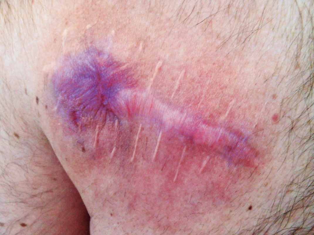 Patient after six months of combined therapy with BRAF and MEK inhibitor