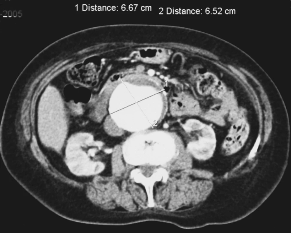 Velké asymptomatické juxtarenální AAA u 81leté nemocné
Fig. 1. Large asymptomatic juxtarenal AAAin a 81-year old female patient