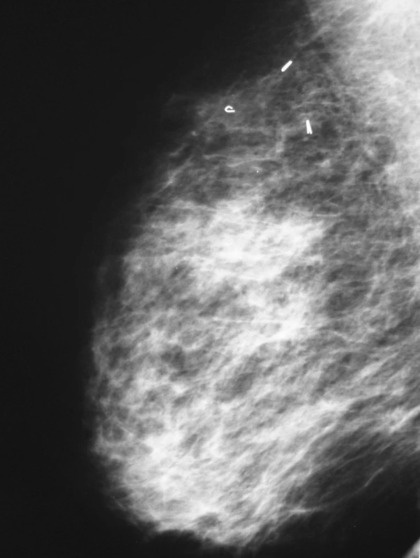 Mammografie po konzervativním výkonu
Pic. 4. Mammography after conservative surgery