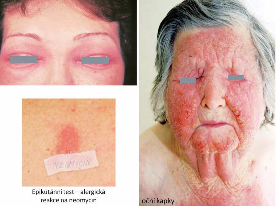 Eczema contactum – neomycin