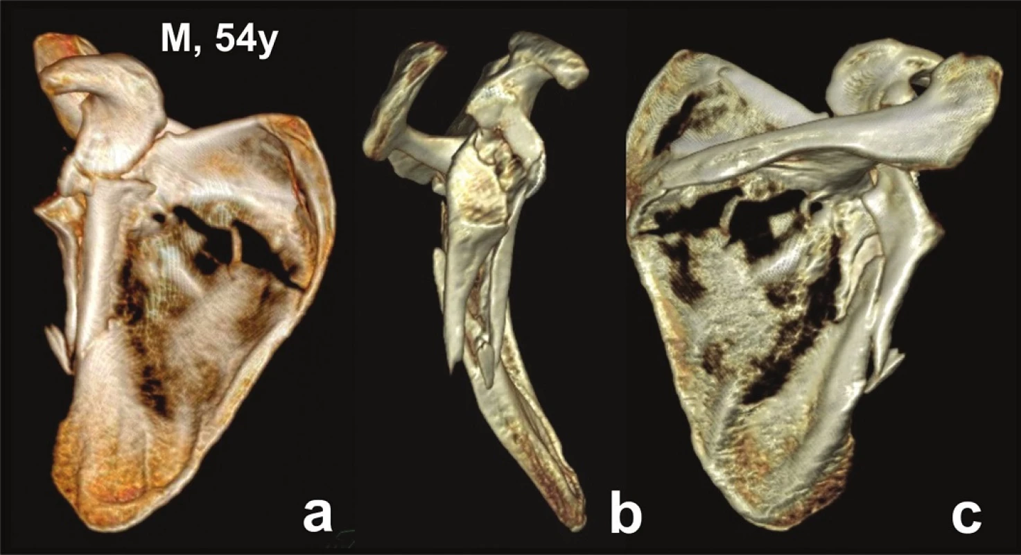 Glenoid fossa fractures (four fragments) with separation in the surgical neck − CT 3D reconstructions (Pt − 9)