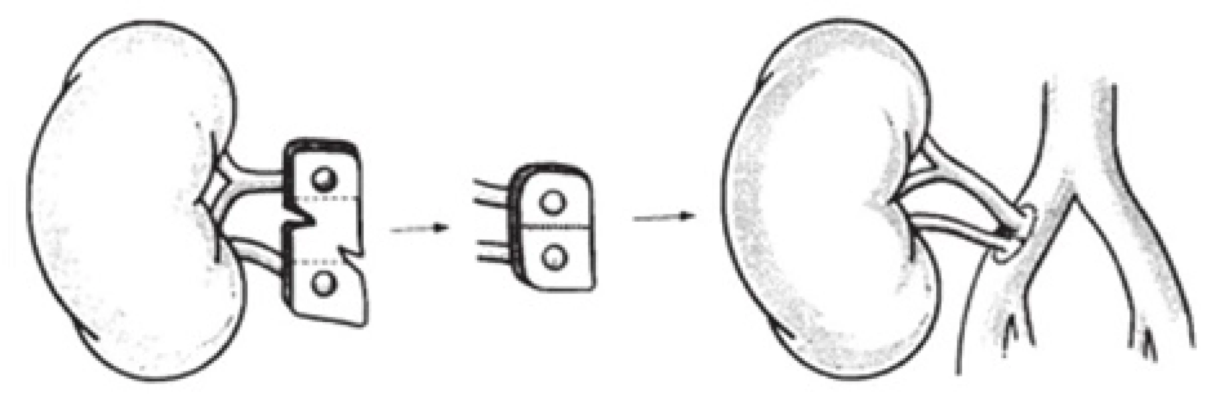 Premodelovanie aortálnej záplaty u obličky s dvojitou artériou [11]
Fig. 2: Remodeling of the aortic pay with double kidney artery [11]