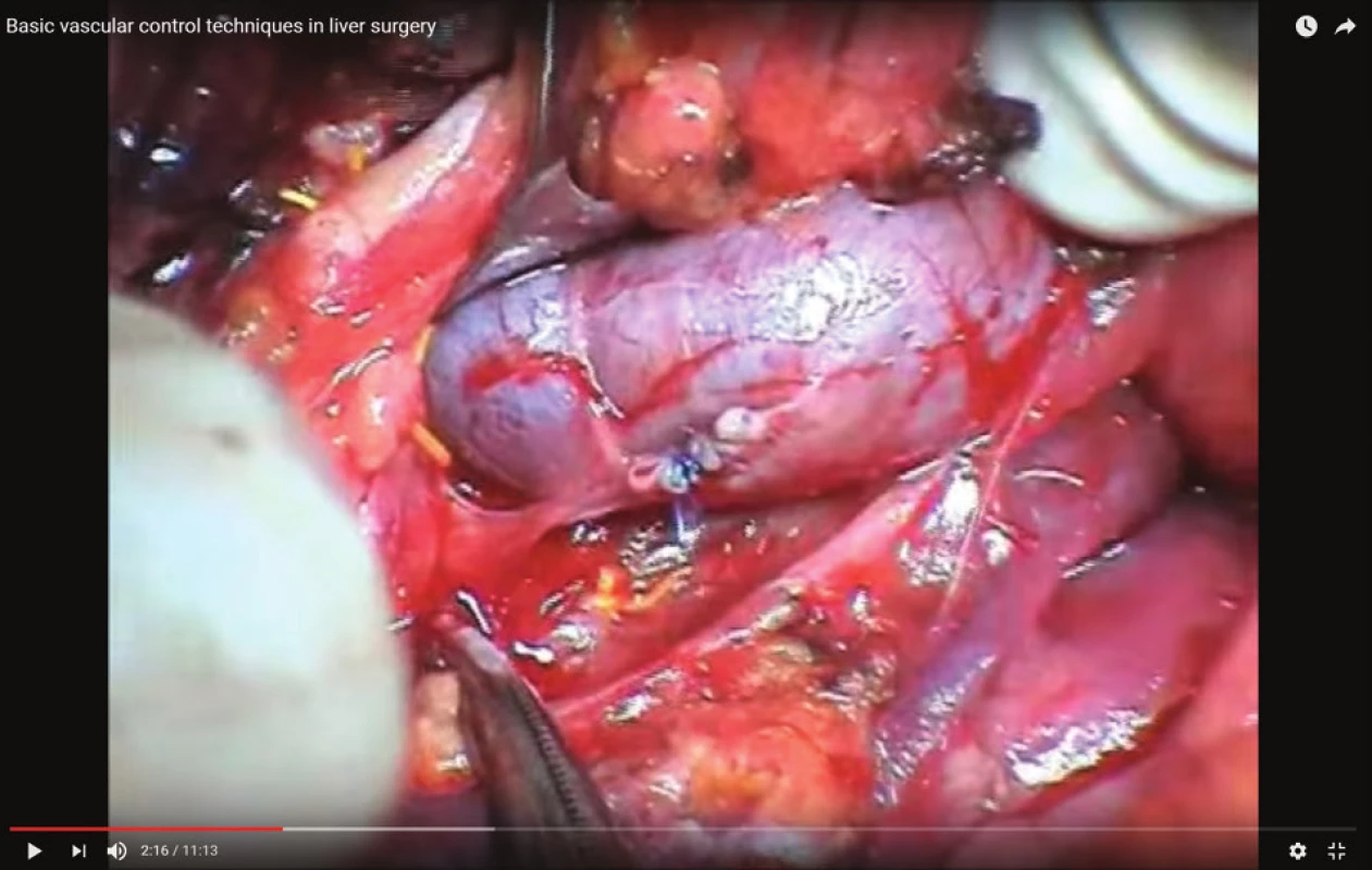 Sutura levé jaterní žíly
Fig. 3: Left hepatic vein suture