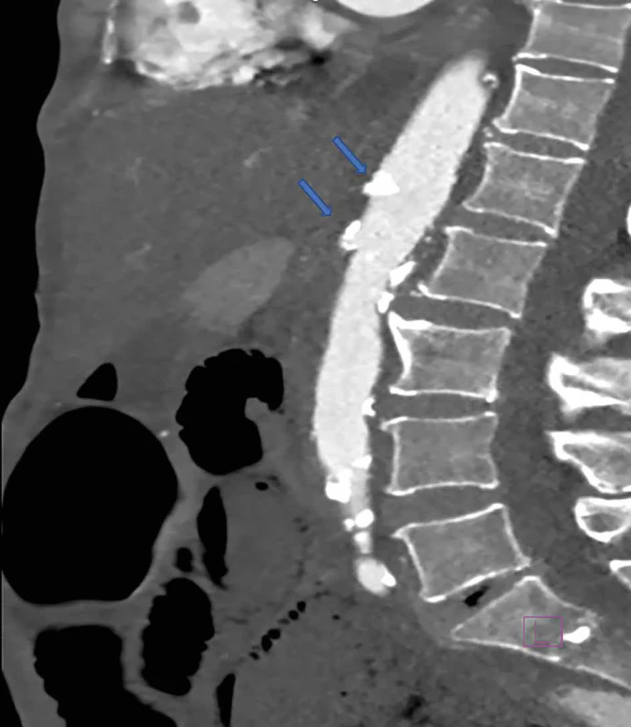 Trombóza TC a AMS   Fig. 1: TC and AMS thrombosis