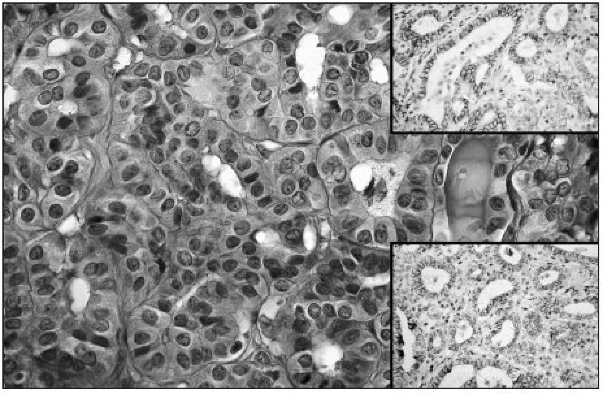 Follicular architecture of fPTC; note intranuclear grooves in some of tumor cells (HE, original magnification 400x). Upper right: Moderate membranous expression of NCAM in fPTC (original magnification 200x). Lower right: Moderate membranous Ecad expression in fPTC (original magnification 200x)