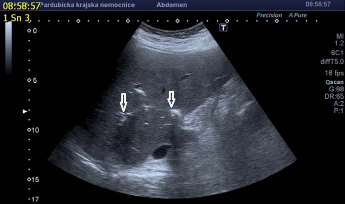 Pneumobilie při ultrazvukovém vyšetření.
Fig. 1. Ultrasound image of pneumobilia.
