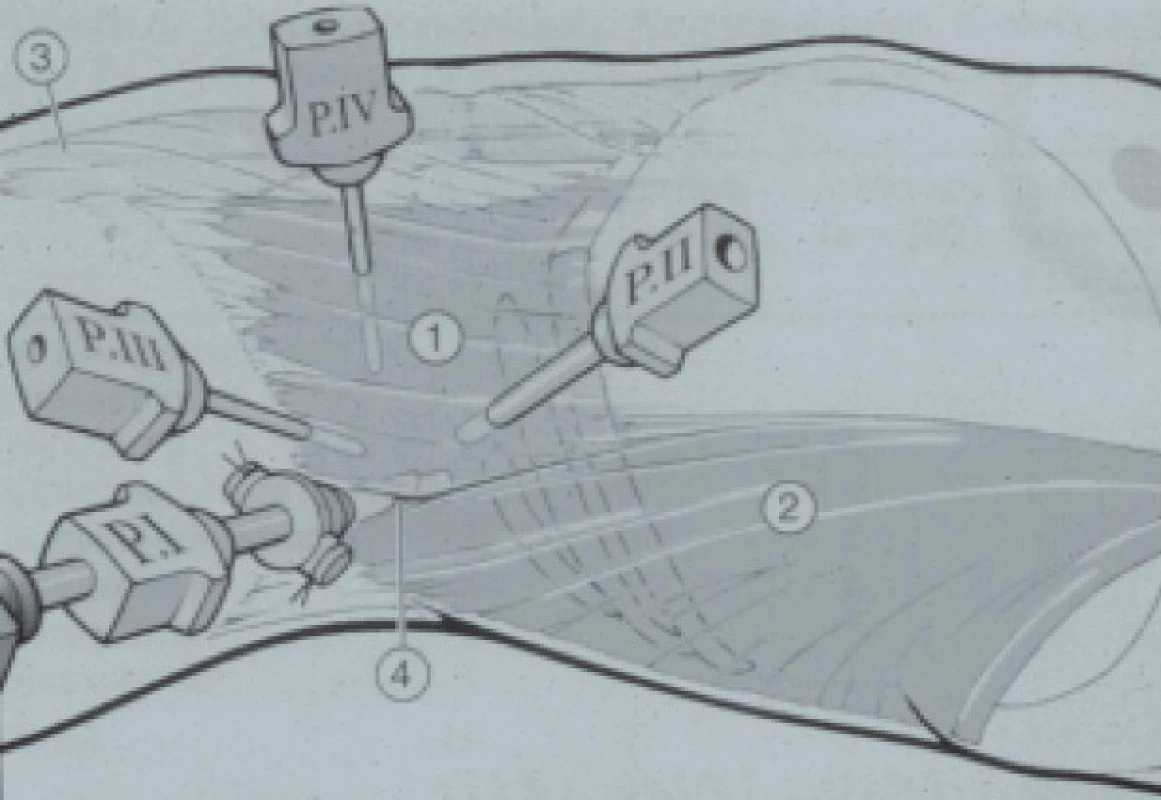 Retroperitoneoskopie. Uspořádání trokarů na pravé straně. 1 = m. obliquus externus, 2 = m. latissimus dorsi, 3 = m. rectus, 4 = lumbální trojúhelník.