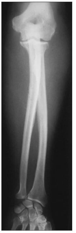 Predozadná RTG snímka ľavého predlaktia bezprostredne po úraze
Fig. 1. Anteroposterior radiograph of the left forearm immediately after injury