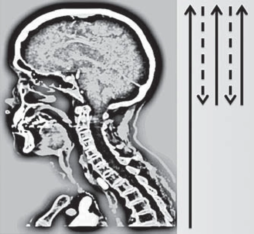Schéma průběhu skenování pomocí multifázické CT angiografi e (Calgary Stroke Program protokol).
Fig. 1. Diagram of scanning using multiphase CT angiography (Calgary Stroke Program protocol).