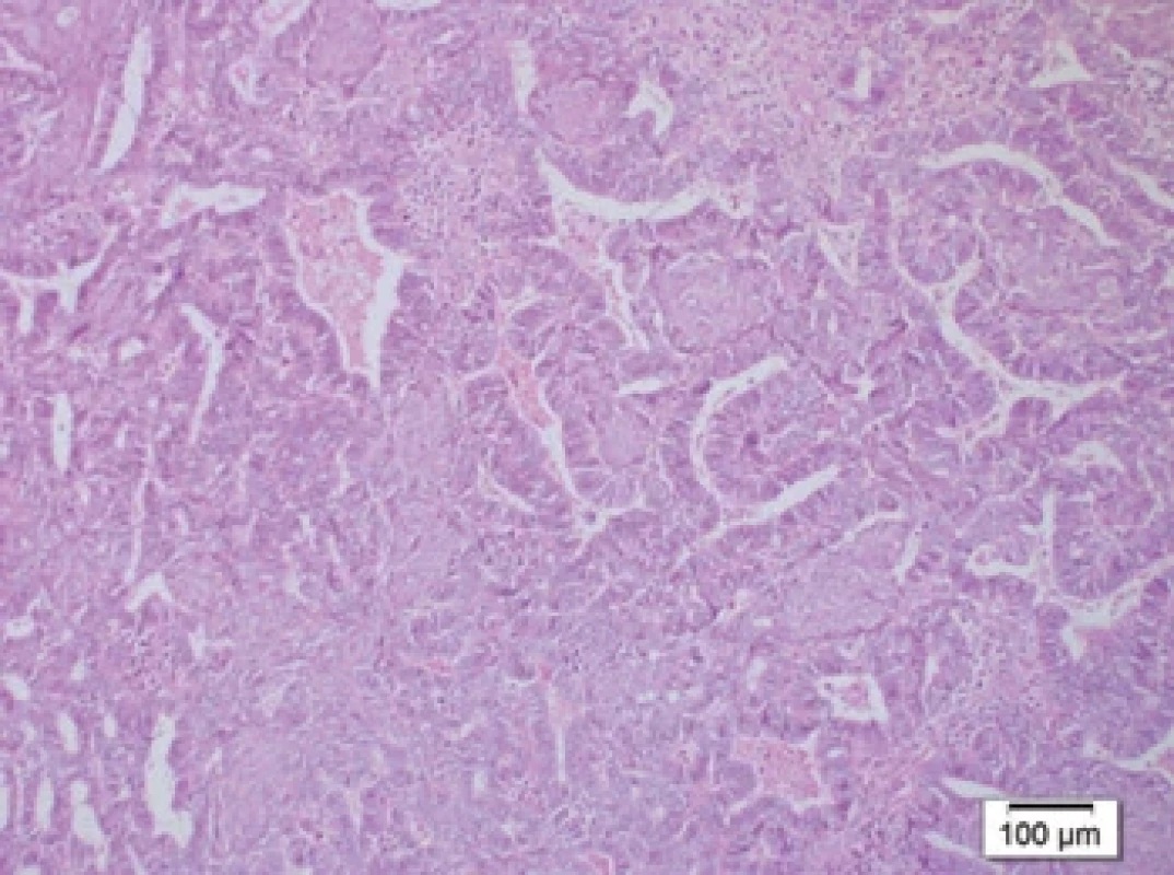 Histopatologický nález – endometroidní karcinom. Fig. 8. Histopathological fi nding – endometrioid carcinoma.