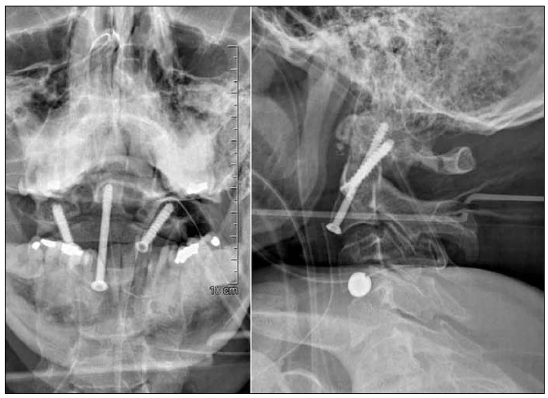Radiologická kontrola anatomického postavení a pozice implantátů po přímé osteosyntéze dentu C2 a anterolaterální transartikulární stabilizaci C2–C1.