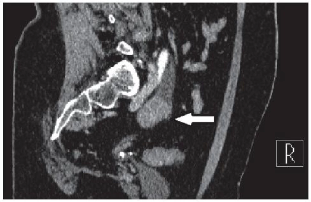 CT po podání kontrastní látky intravenózně – šipka ukazuje na tumor močovodu
Fig. 2. CT after administration of intravenous contrast material – the arrow points to the tumor ureter