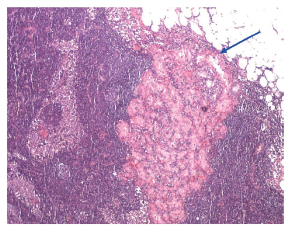 Metastáza MPTC v lymfatické uzlině<br>
Fig. 2: MPTC metastasis in lymph node