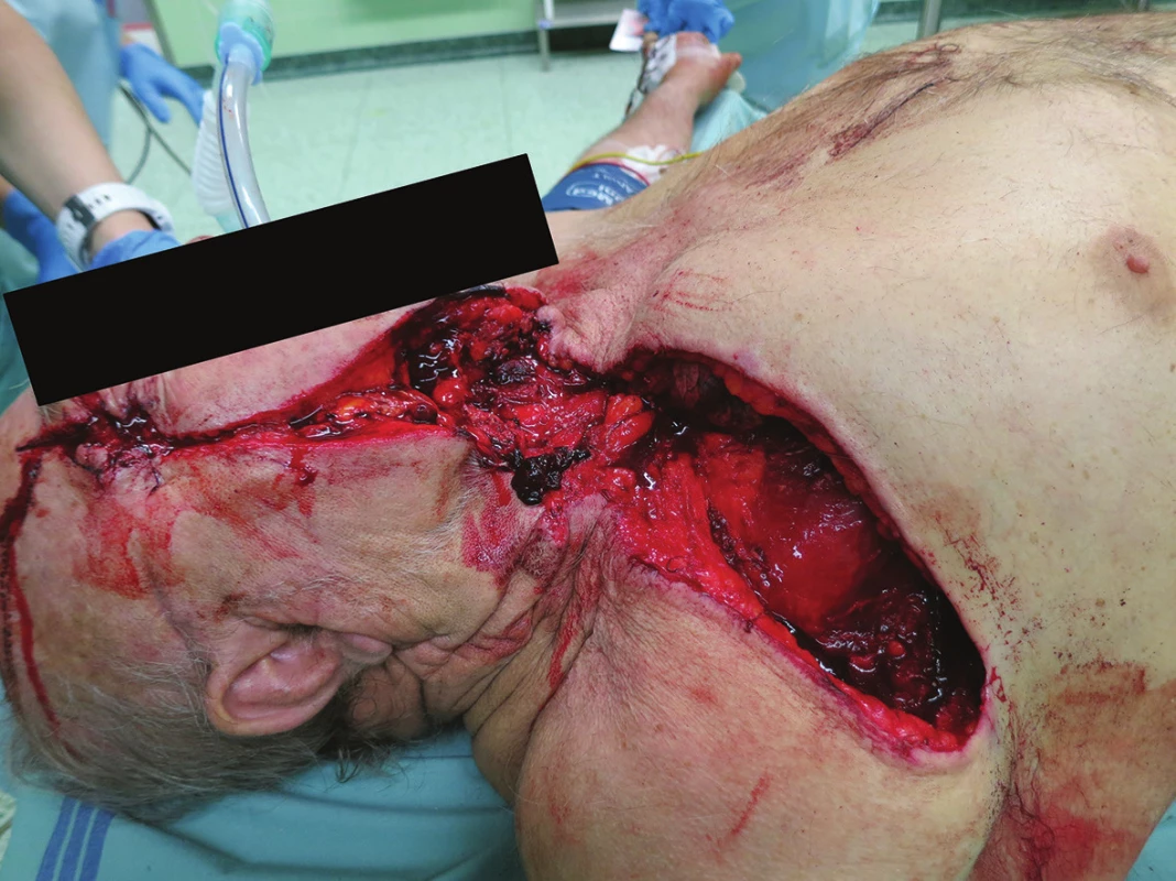 Otevřené poranění hlavy, krku a hrudníku (penetrující) okružní pilou
Fig. 1: Open injury of the head, neck and chest (penetrating) by a circular saw