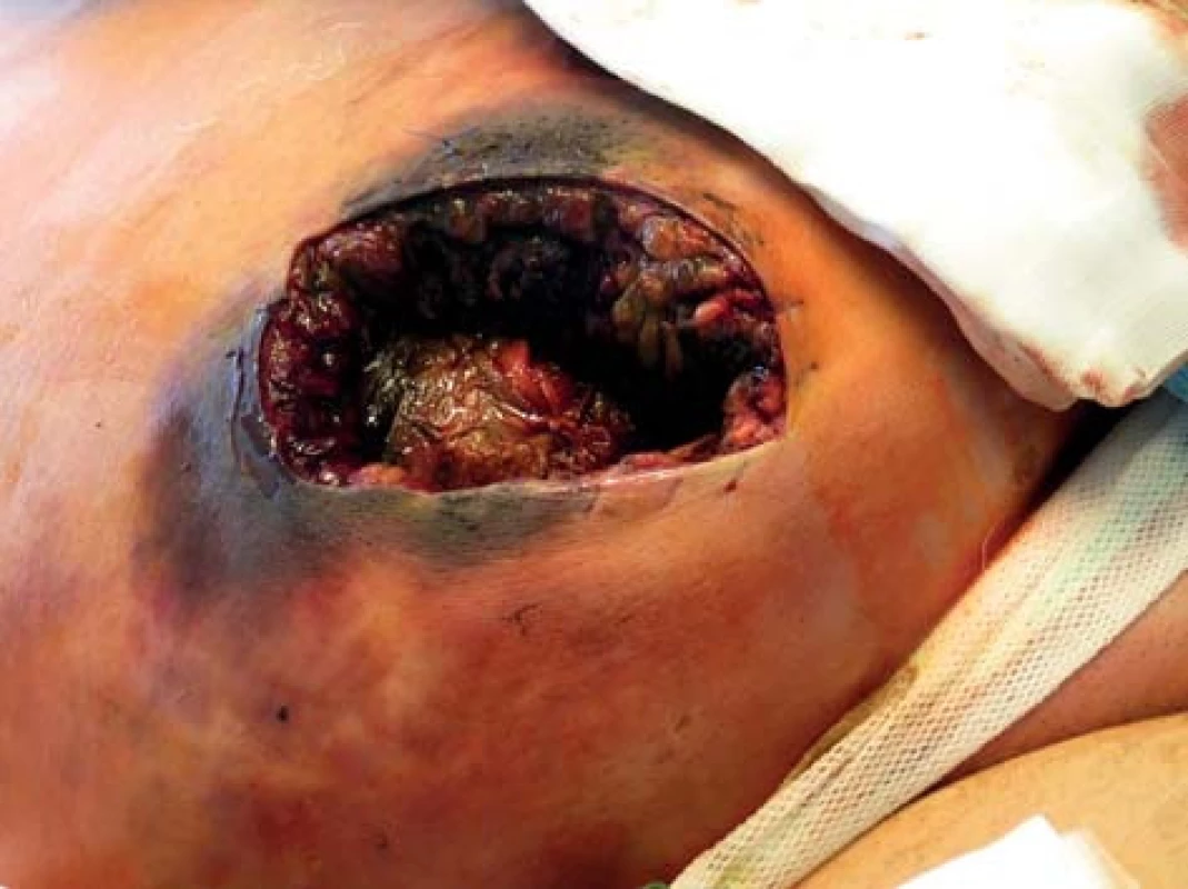 Lokální nález operační rány s obsahem nekrotických tkání
Fig. 1: Local finding of the operating field with necrotic tissue