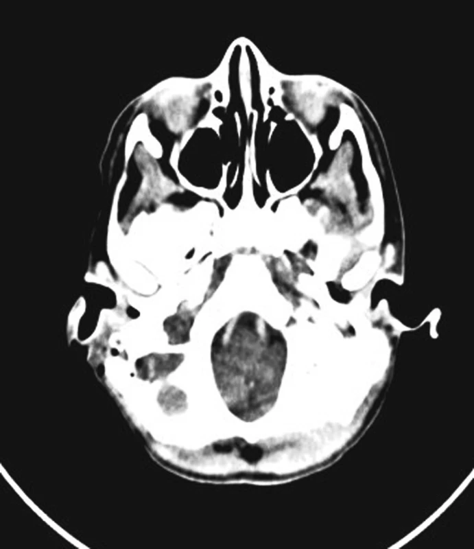 Trombus v sifonu sinus sigmoideus.