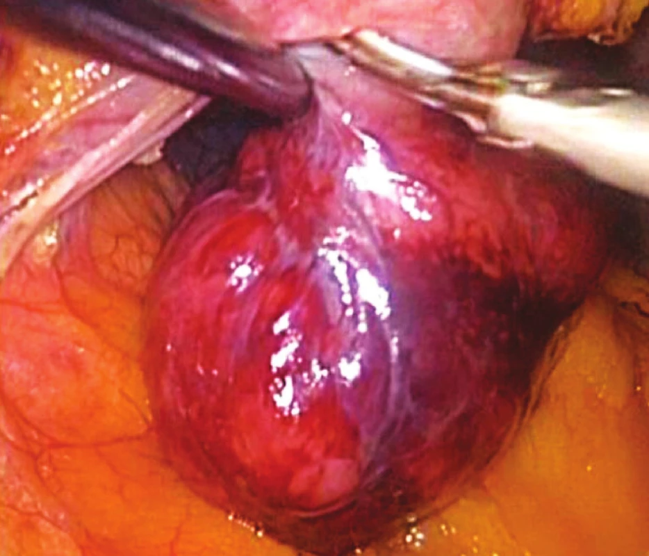 Peroperační snímek GIST zadní stěny žaludku
Fig. 4. Intraoperative view of GIST located within the posterior gastric wall
