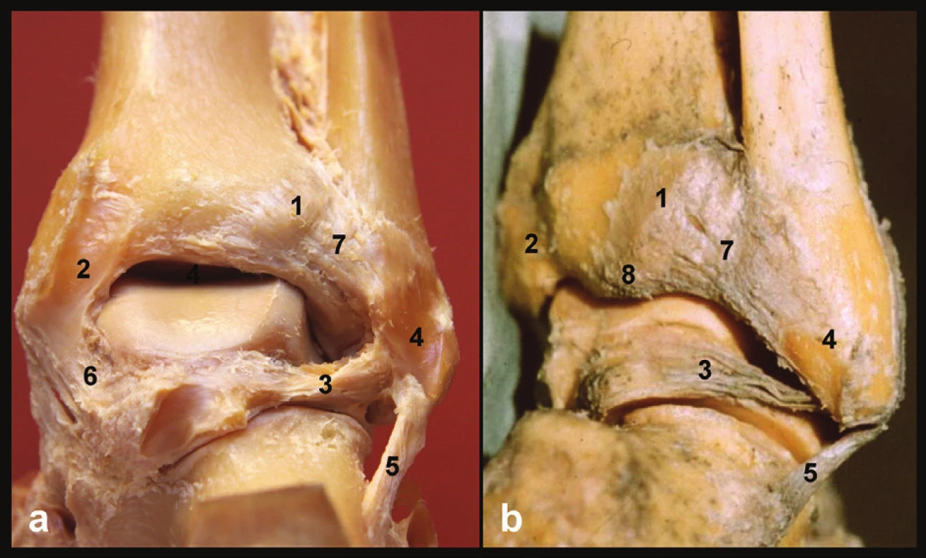Anatomie zadní hrany tibie, pravé hlezno
a – pohled zezadu, b – pohled posterolaterální, 1 – tuberculum posterius tibiae, 2 – sulcus tendinis m. tibialis posterior, 3 – lig. talofibulare posterius, 4 – sulcus malleoli lateralis, 5 – lig. fibulocalcaneare, 6 – tibio-talární část deltového vazu, 7 – lig. tibiofibulare posterius, 8 – zadní malleolus. Převzato z [11].
Fig. 1: Anatomy of posterior tibial rim, right ankle
a – posterior view, b –posterolateral view, 1 – tuberculum posterius tibiae, 2 – sulcus tendinis m. tibialis posterior, 3 – lig. tibiofibulare posterius, 4 – sulcus malleoli lateralis, 5 – lig. fibulocalcaneare, 6 – tibio-talar part of deltoid ligament, 7 – lig. tibiofibulare posterius, 8 – malleolus posterior. Courtesy of [11].