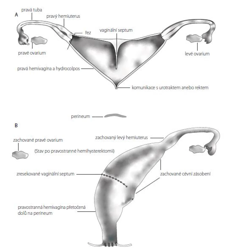 A, B. Přetočení septované pochvy a její stažení na hráz, tzv. „vaginal switch“ (převzato a upraveno z Levitt
MA, Peña A. Cloacal malformations: lessons learned from 490 cases. Semin Pediatr Surg. 2010 May; 19(2): 128–138)<br>
Fig. 4 A, B. Switching of a septate vagina and bringing it to the perineum, aka vaginal switch manoeuvre
(Adapted from Levitt MA, Peña A. Cloacal malformations: lessons learned from 490 cases. Semin Pediatr Surg.
2010; 19(2): 128–138)