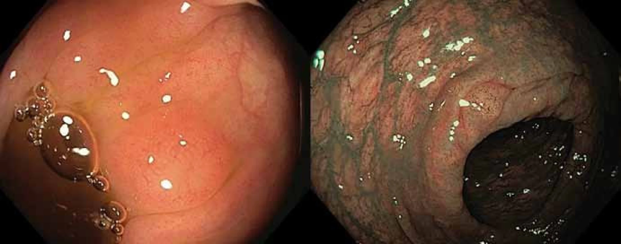 Infiltrace sliznice tlustého střeva malobuněčným lymfomem napodobující hyperplastický polyp v bílém světle (vlevo) a s využitím narrow band imaging (vpravo).
Fig. 2. Infiltration of colonic mucosa by small cell lymphoma mimicking a hyperplastic polyp in white light (left) and narrow band imaging (right).