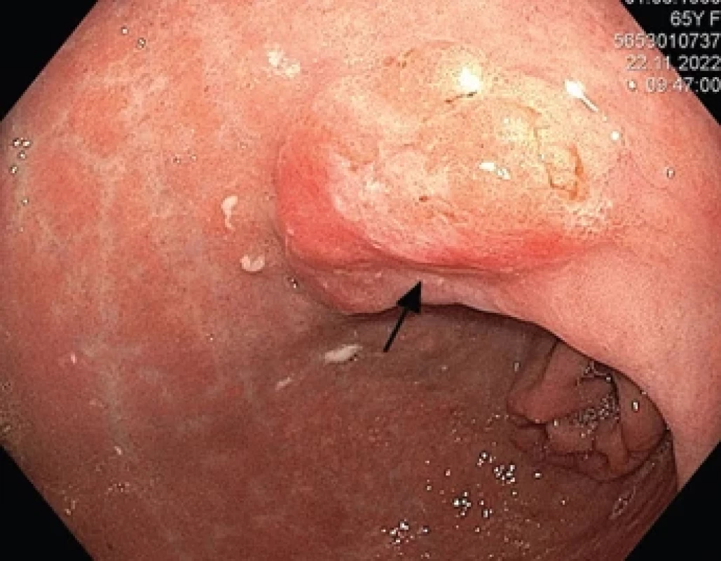 Gastroskopický obraz karcinom žaludku distálně od kardie velikosti 30 × 15 mm. Pacientka byla indikována k endoskopické submukózní disekci (ESD), s histopatologickým nálezem pT1 karcinomu a R0 resekce. Pro přítomnost histologické lymfangioinvaze byla indikována k robotické subtotální gastrektomii.