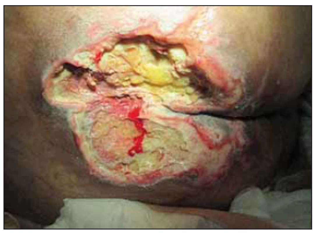 Case study C – 21<sup>st</sup> postoperative
day, pressure ulcer in the sacral region –
National Pressure Ulcer Advisory Panel
(NPUAP) IV. category.<br>
Obr. 7. Klinický prípad C – 21. pooperačný
deň, dekubitus v sakrálnej oblasti, IV. stupeň
podľa National Pressure Ulcer Advisory
Panel (NPUAP).