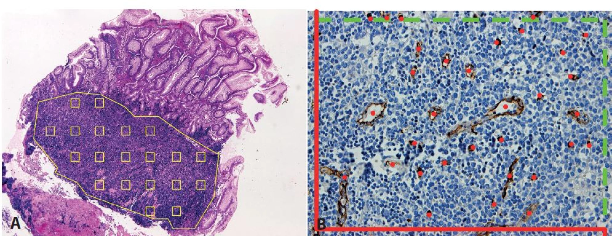 Stanovení mikrovaskulární denzity pomocí metody systematického náhodného výběru zorných polí v definované oblasti. <b>A</b>: vzorkování v mantle cell lymfomu (MCL) infiltrujícím sliznici tlustého střeva (hematoxylin-eosin, zvětšení 50x). <b>B</b>: označení počítaných profilů mikrocév v jednom zorném poli MCL v lymfatické uzlině s využitím počítacího rámečku pro tzv. nevychýlené počítání (42), který sestává ze zakázaných linií (červeně, protínající cévní profily nejsou započítány) a povolených linií (zeleně přerušovaně, dotýkající se cévní profily jsou započítány) (protilátka CD34, zvětšení 200x).