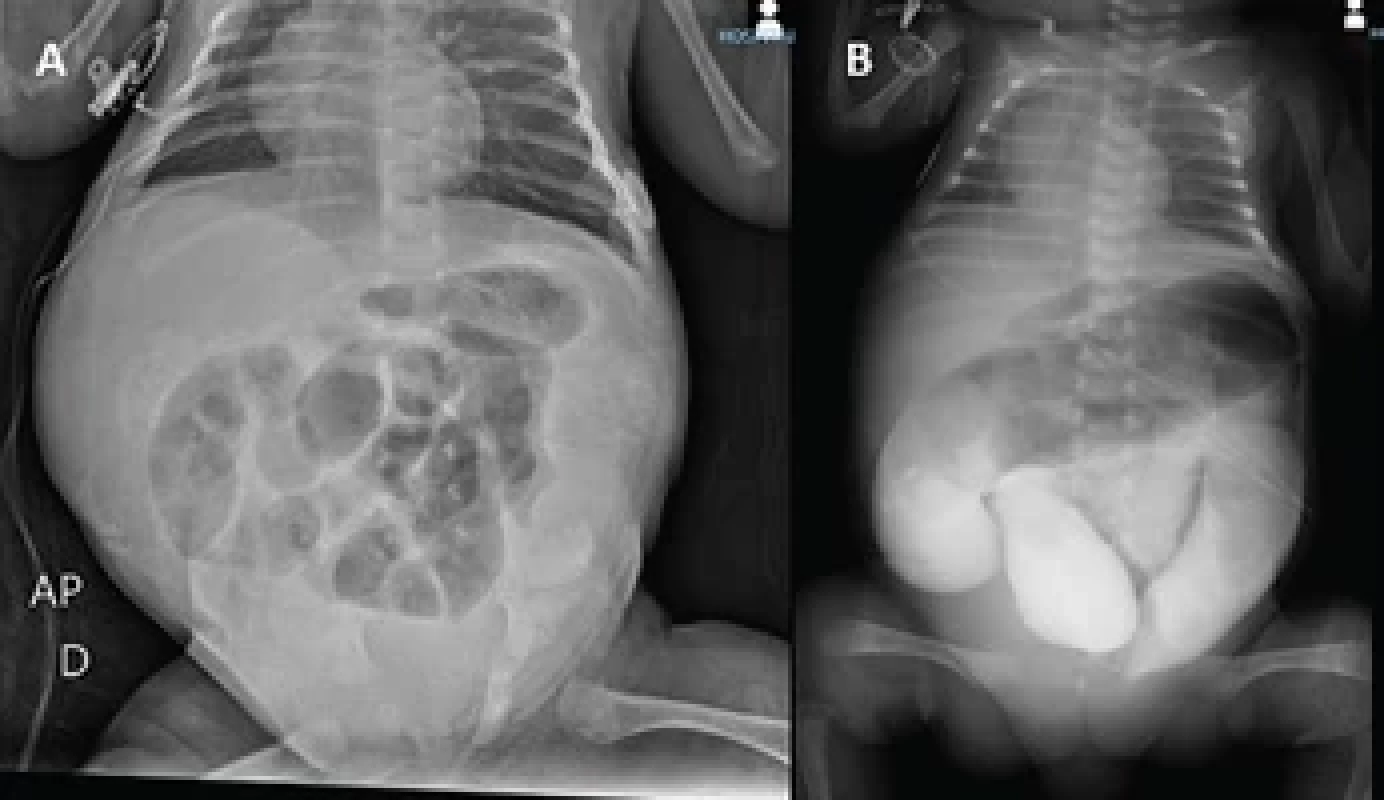 A) Abdominal distension on postnatal abdominal X-ray. B) Opaque enema at 30 days of age showing intestinal distension and obstruction of the intestinal tract.