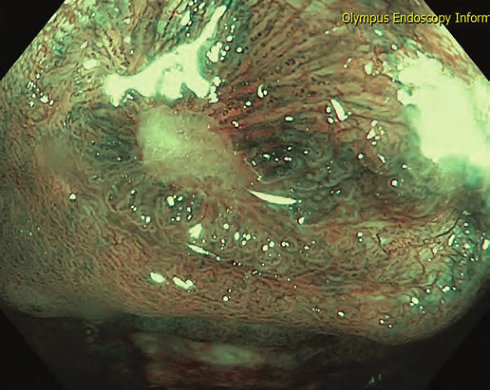 Hojení ulcerací během terapie adalimumabem – NBI.
Fig. 5. Mucosal healing during adalimumab therapy – NBI.