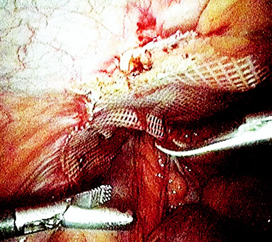 Laparoskopická operace tříselné kýly s použitím síťky
Fig. 1. Laparoscopic inquinal hernia surgery using the mesh