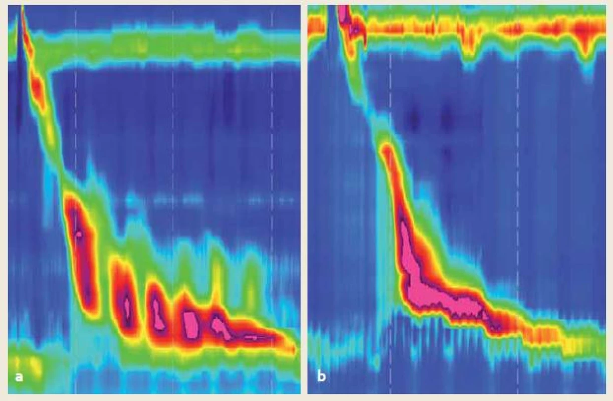 a) Hyperkontraktilita s repetitívnymi kontrakciami s DCI > 8 000 mmHg/cm/s, typická pre Jackhammer pažerák, b) tzv. hypertenzná kontrakcia podľa klasifikácie z r. 2012. Jej signifikancia je nízka a vo v3.0 je klasifikovaná ako normálna.
Fig 2. a) Hypercontractility with repetitive contractions with DCI > 8,000 mmHg/cm/s typical for Jackhammer esophagus, b) hypertensive peristalsis according to the Chicago classification criteria 2012. Low signifi cance, classified as normal according to the v3.0.