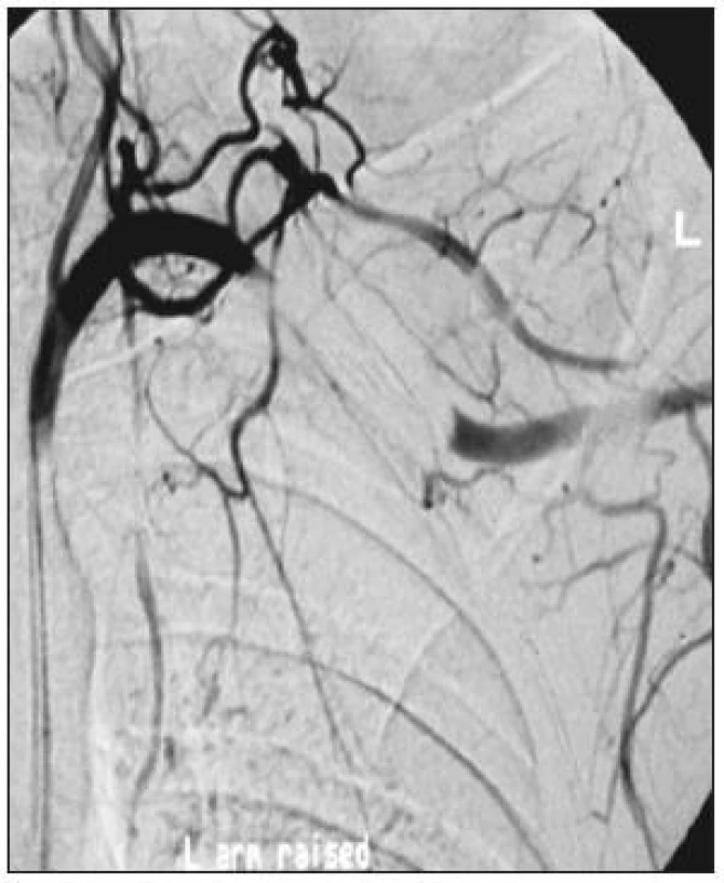Uzávěr v. subclavia při elevované končetině u pacienta s TOS
Fig. 1. Closure of v. subclavia in an elevated extremity in a patient with TOS
