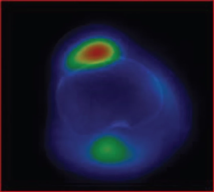 SPECT/CT pravého kolenního kloubu v časné fázi v axiálním řezu – krevní pool zvýšen v oblasti, která odpovídá lokalizaci hluboké infrapatelární burzy.